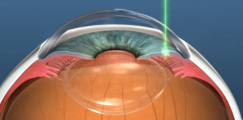 Diagram showing a YAG laser peripheral iridotomy to treat narrow angles or angle closure glaucomaDiagram showing a YAG laser peripheral iridotomy to treat narrow angles or angle closure glaucoma