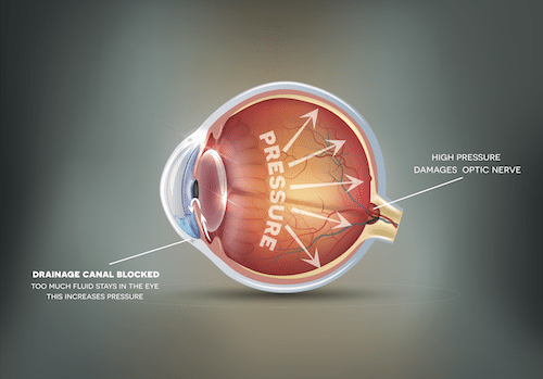 Diagram of an eye showing what happens in glaucoma