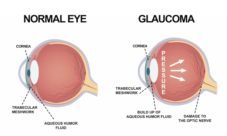 Diagram comparing a normal eye and an eye with glaucoma