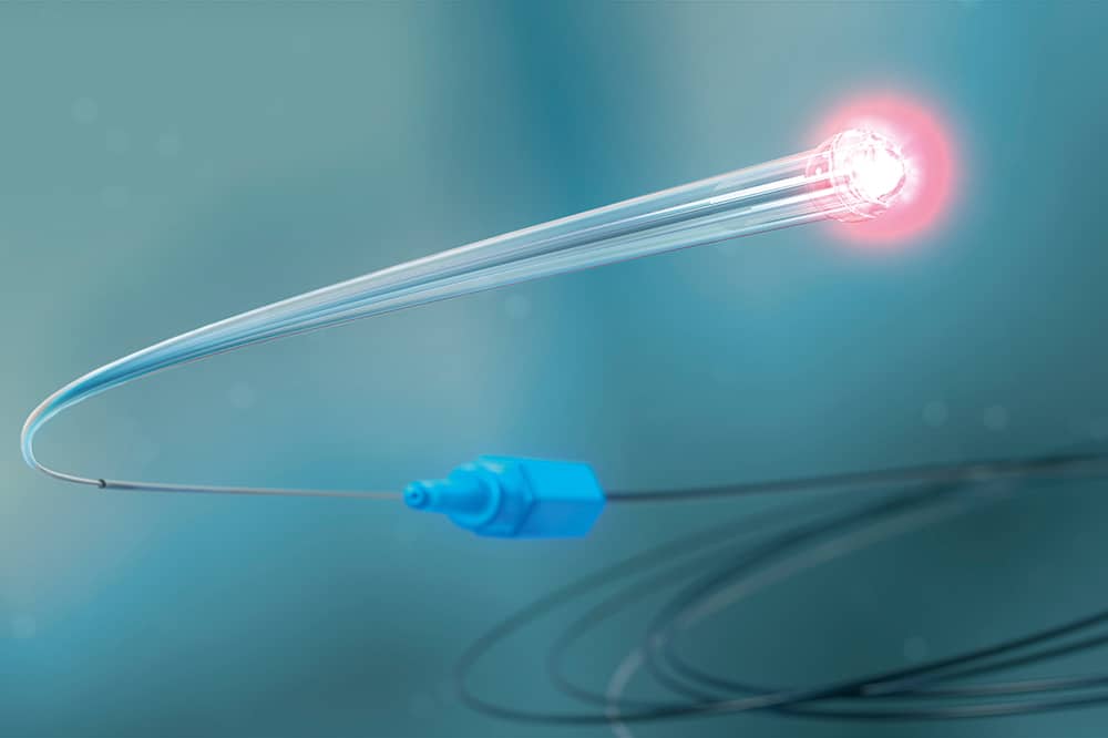 Illustration of the iTrack glaucoma surgery microcatheter