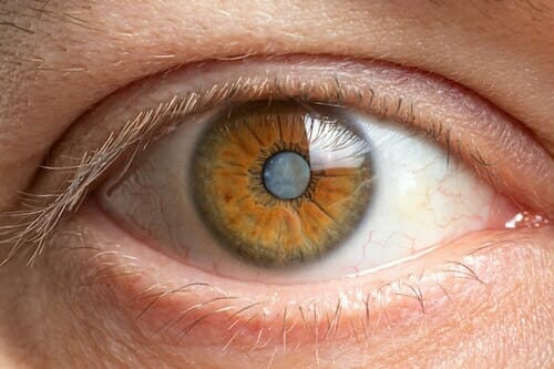 Picture of an eye with cataract