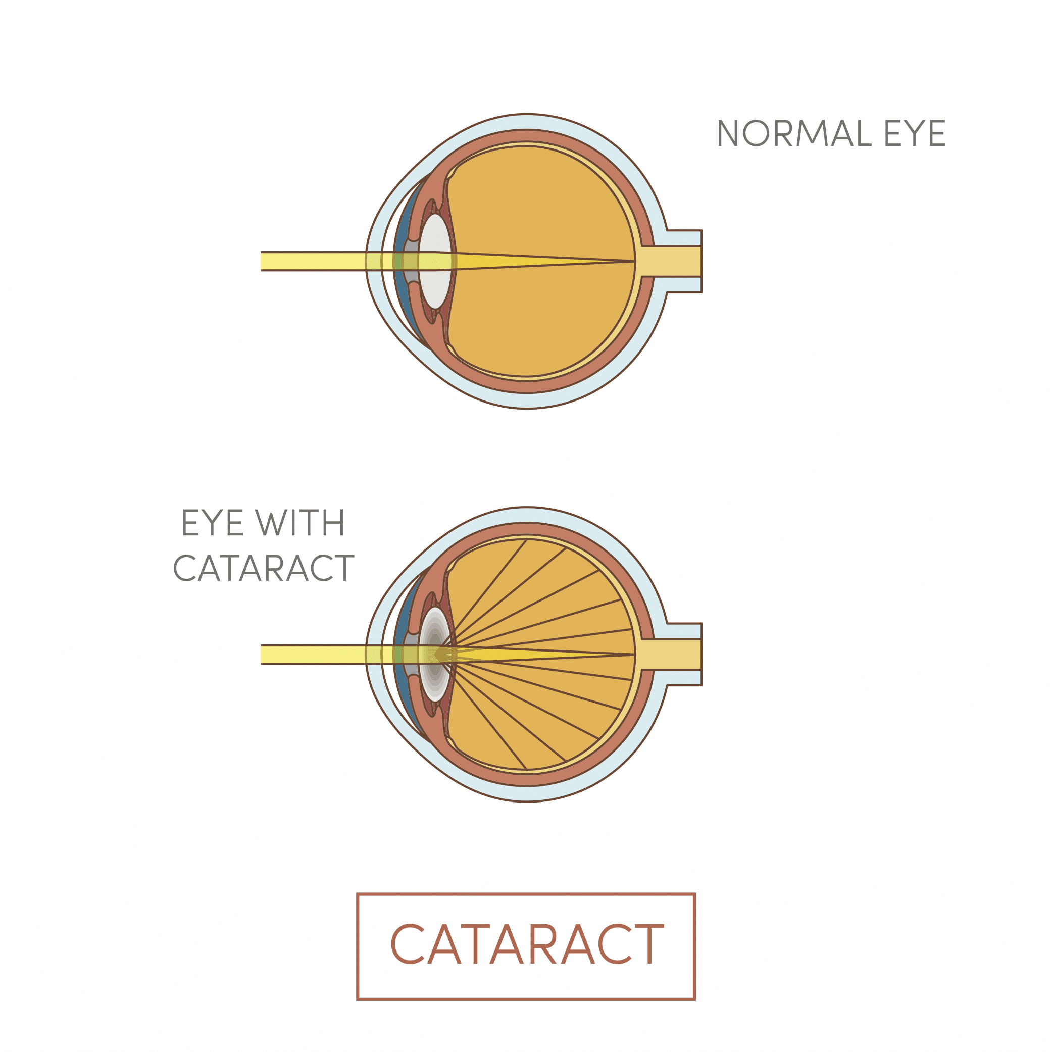 Medical illustration of a normal eye and an eye with cataract