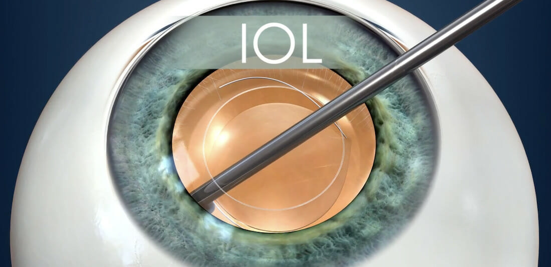 Diagram of the intraocular lens inserted inside the eye during cataract surgery