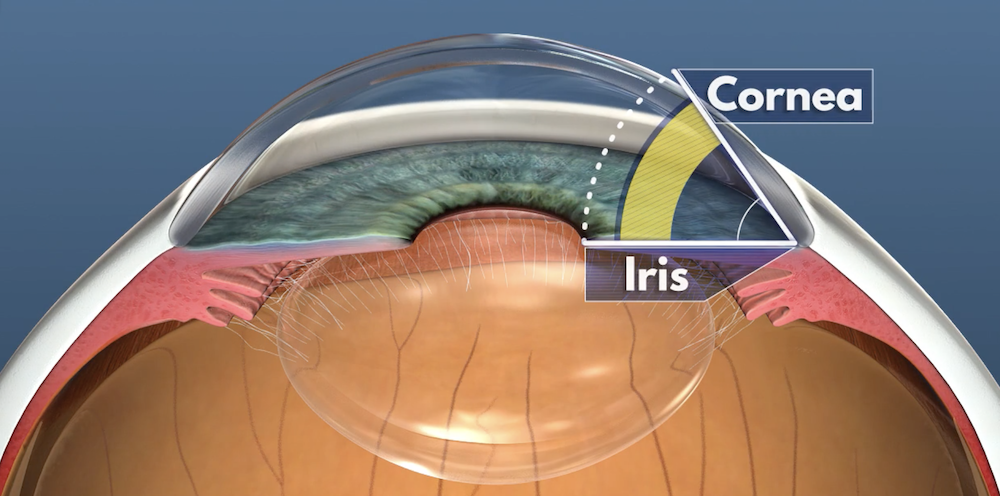 Diagram of an eye showing the angle between the iris and the cornea