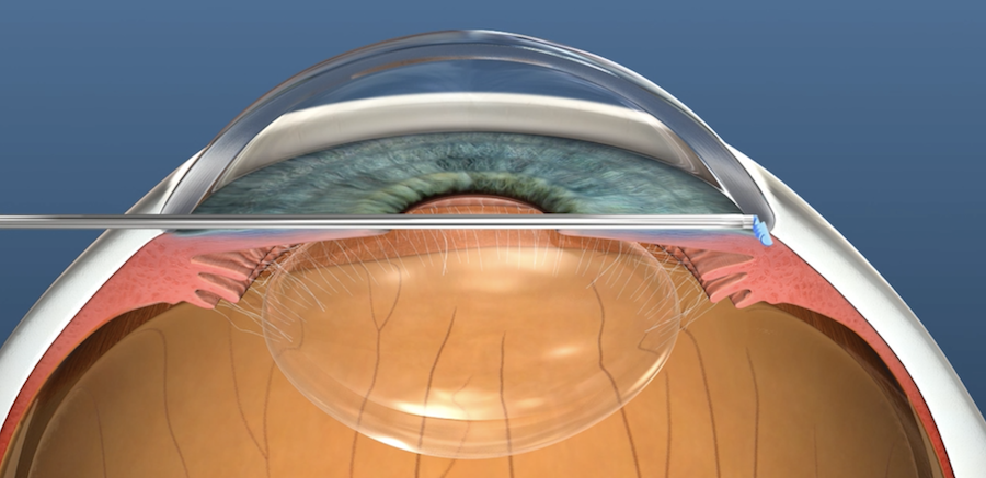 Surgery for glaucoma
