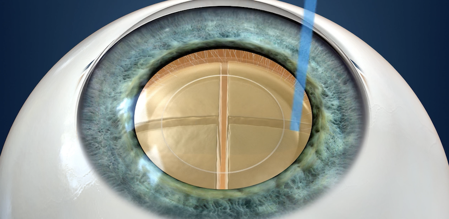 Laser-assisted cataract surgery