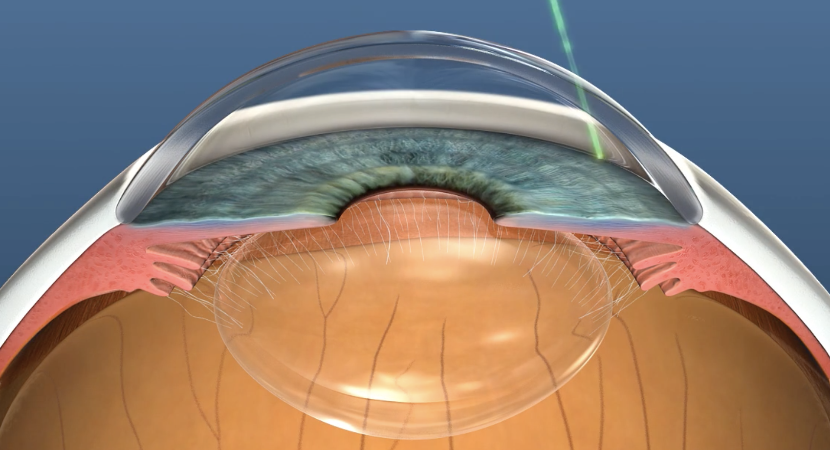 Diagram showing laser light treating the drainage channel of the eye in selective laser trabeculoplasty