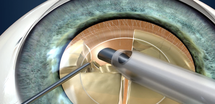 Lens extraction surgery for the treatment of glaucoma