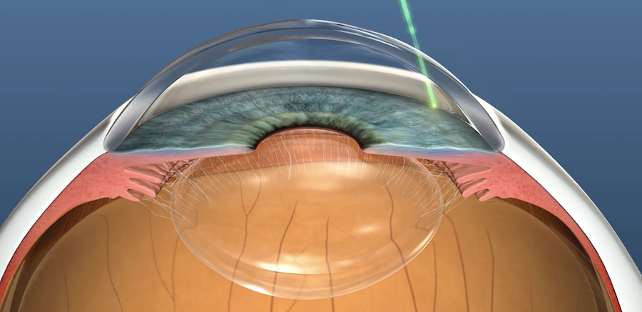 Selective laser trabeculoplasty being performed for glaucoma