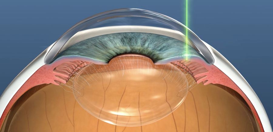 YAG laser peripheral iridotomy to treat angle-closure glaucoma